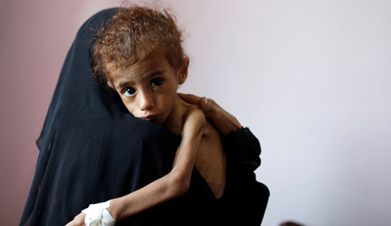 CNN: Yemen’de 400 bin çocuk açlıktan ölmek üzere